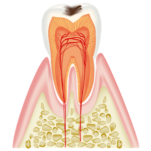 1〜2mm程度の虫歯（c1）